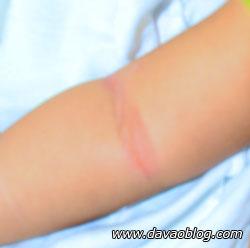 arms-rashes-eczema