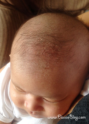 How to treat baby’s dandruff or scalp flakes